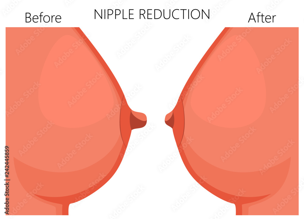 Vector illustration of the nipple reduction before and after plastic  surgery. Side view of the woman breast. For advertising and medical  publications Stock Vector