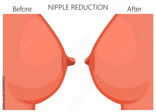 Vector illustration of the nipple reduction before and after plastic surgery. Side view of the woman breast. For advertising and medical publications photo