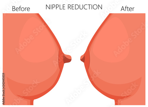 Vector illustration of the nipple reduction before and after plastic surgery. Side view of the woman breast. For advertising and medical publications