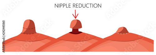 Vector illustration of the long nipple reduction before and after plastic surgery. Side view (close up) of the woman breast. For advertising and medical publications.