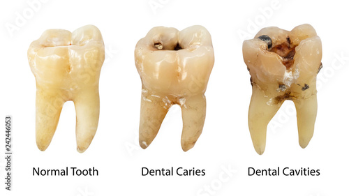 Fotografie, Obraz Normal tooth , Dental caries and Dental cavity with calculus