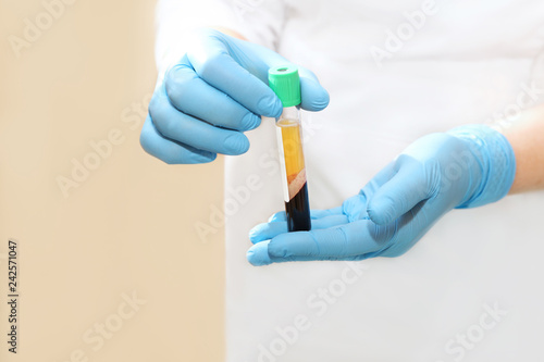 Medical test tube with blood Plasma in his hands for PRP therapy