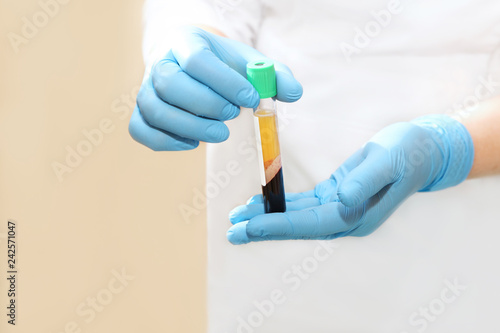 Canvastavla Medical test tube with blood Plasma in his hands for PRP therapy