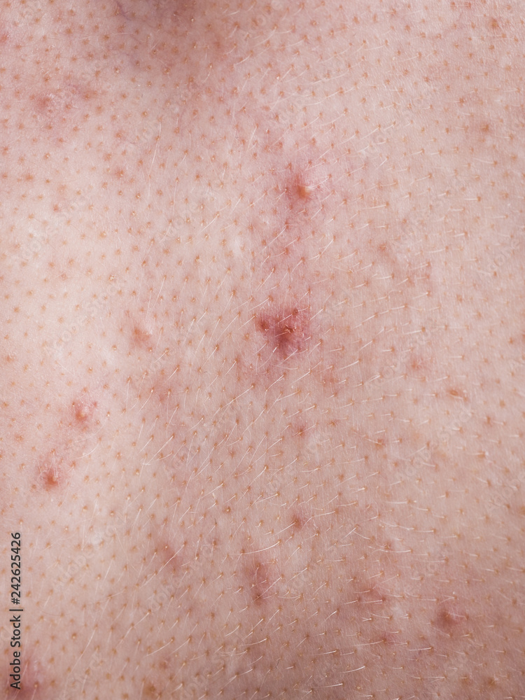 Closeup human skin with problem Closeup human skin with problem