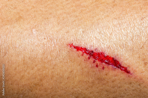 Closeup deep wounds from sharp objects on human skin.