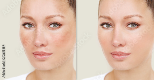 Картината върху платно Dark spots, freckles,hyperpigmentation(melasma or chloasma)