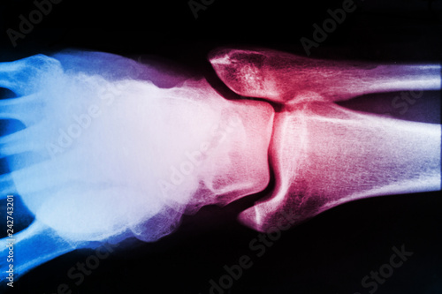 Color x ray hand scan with red color indicating pain spot medical background. 