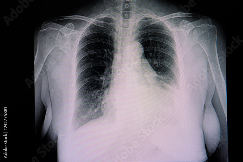 x ray film of a patient with cardiomegaly and left pleural effusion photo