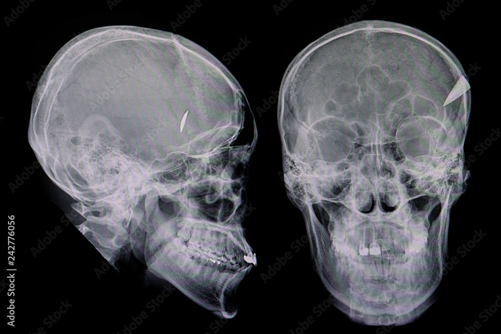 a knife penetrating a skull a knife penetrating a skull