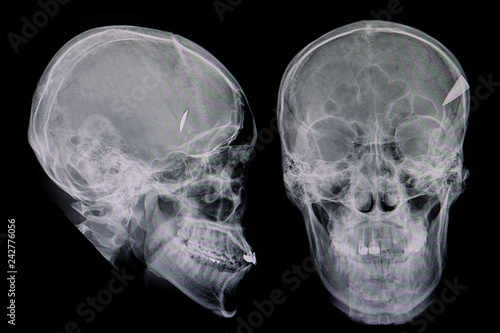 Fotografija a knife penetrating a skull