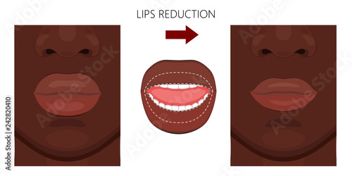 Vector illustration. African American Lips reduction before and after procedure. Close up view. For advertising of medicinal, pharmacy products, cream, lotion, cosmetic and plastic procedures