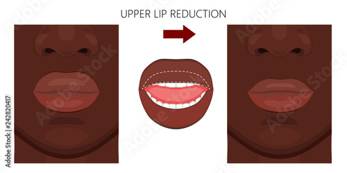 Vector illustration. African American upper lip reduction before, after procedure. Close up view. For advertising of cosmetic plastic procedures; for medical and beauty publications