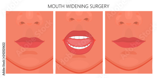 Vector illustration. Mouth widening surgery on face before, after procedure. Close up view. For advertising of medicinal, cosmetic, plastic surgery, procedures