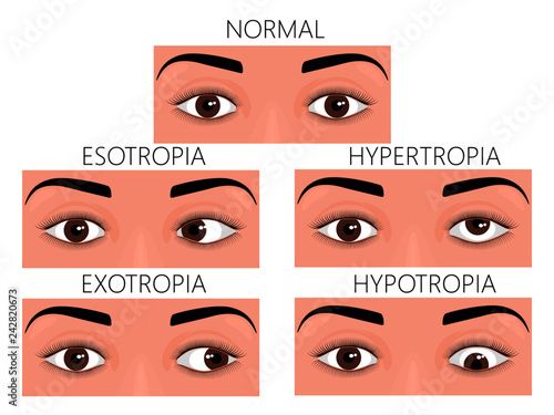 Vector illustration of normal human eyes and eyes with problem. Strabismus or crossed eyes types - esotropia, exotropia, hypertropia, hypotropia. For advertisement and medical publications.