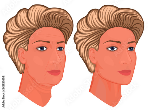 Vector illustration. A female face before, after plastic surgery - facial rejuvenation, face lift. Close up view. For advertising of cosmetological procedures, medical and beauty publications