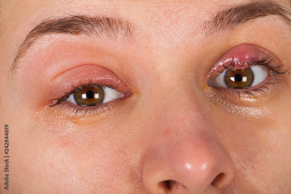 Upper eyelid infection - chalazion Upper eyelid infection - chalazion