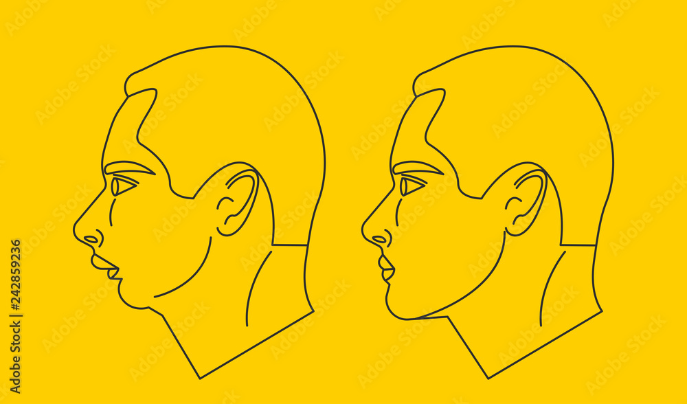 Distal bite line illustration