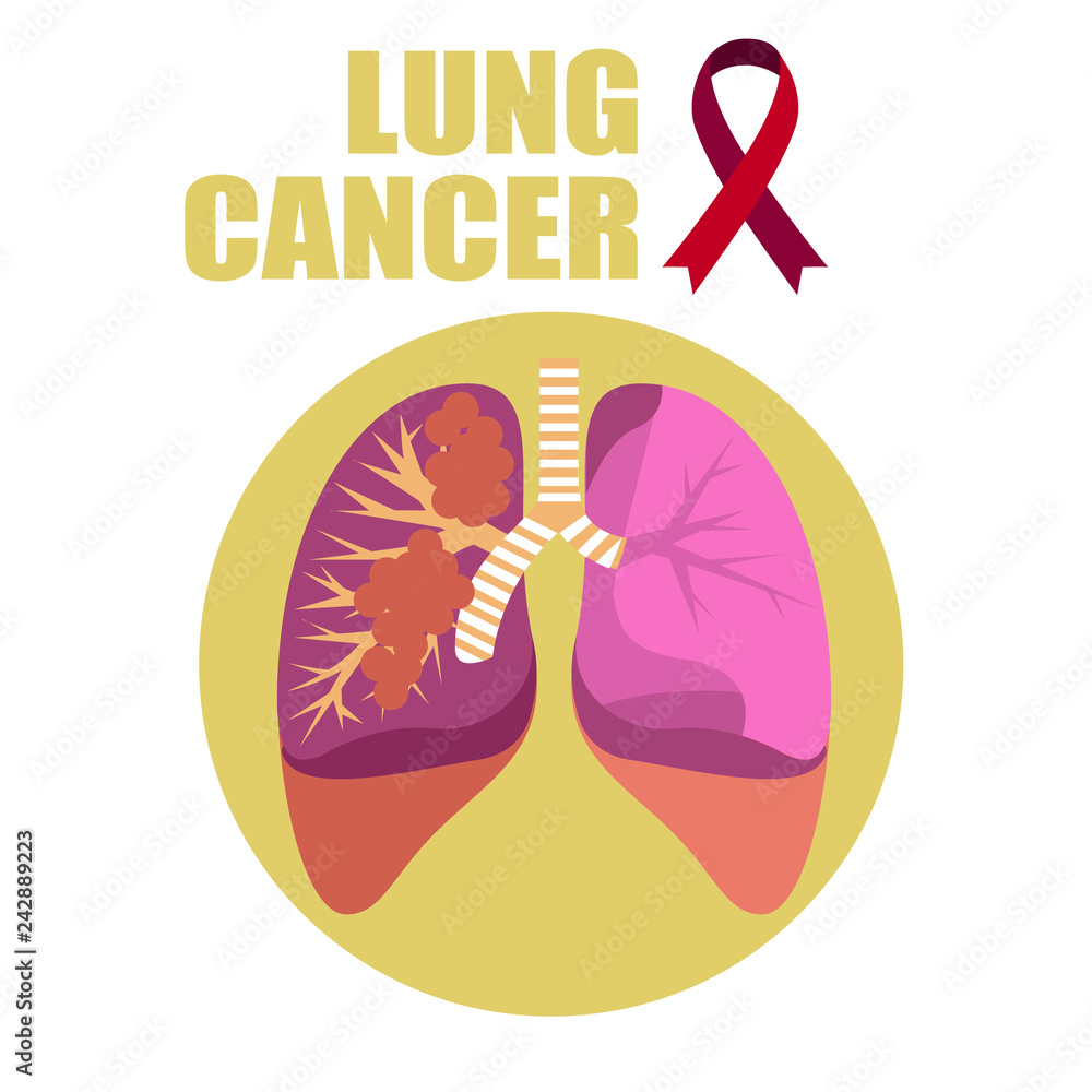 Human lungs are affected by cancer. Human health. Human lungs are affected by cancer. Human health.