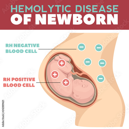 Obraz na plátne Hemolytic disease of newborn infographics