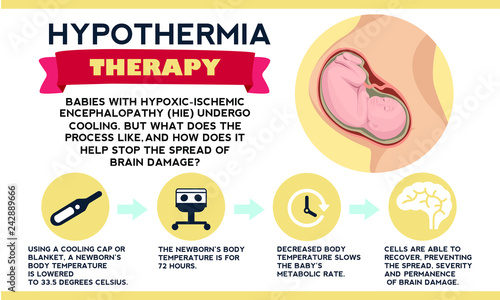 Therapeutic hypothermia. Treatment for hypoxic ischemic encephalopathy (HIE). Detailed vector Infographic. Baby Health