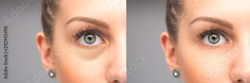 Eyes before and after elimination of swelling