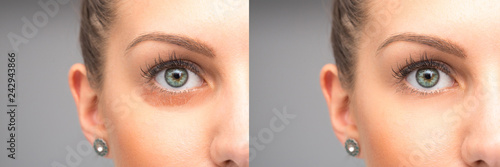 Puffiness under eyes removal before and after treatment