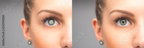 Female eye before and after cataract removal