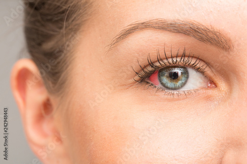 Fototapeta Naklejka Na Ścianę i Meble -  Red spot in eye sclera