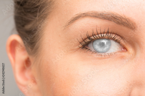 Fototapeta Naklejka Na Ścianę i Meble -  Illustration of human eye affected by corneal opacity