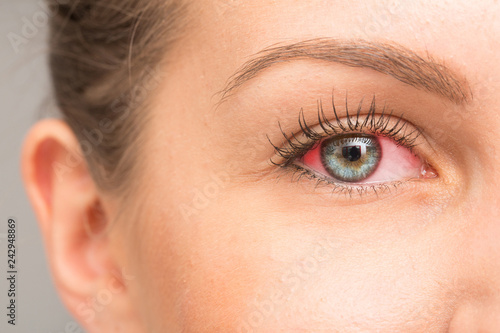 Fototapeta Naklejka Na Ścianę i Meble -  Red eye for irritation of the sclera