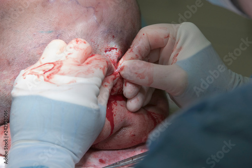 Surgeon connects tissue expander to a tube after the setting under the head skin during the head tumor operation
