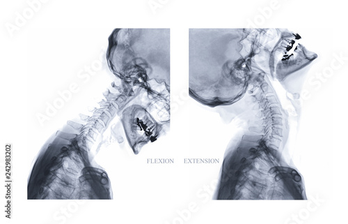 X-ray image of Cervical spine Lateral Flexion and extension view show iintervertebral disc herniation. medical concept. photo