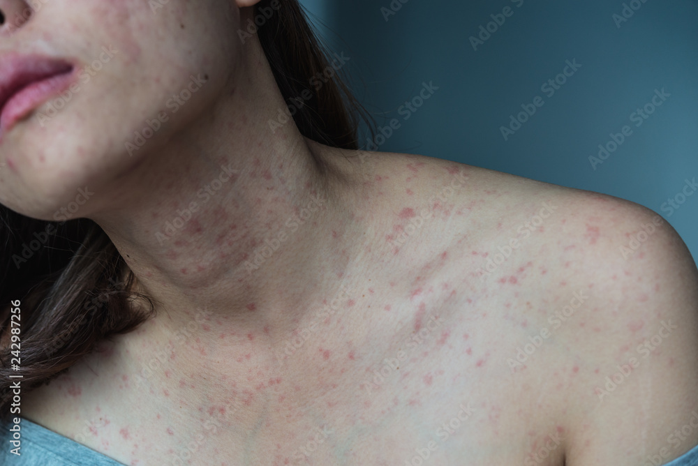 Skin Allergy Symptoms of patient,Allergic skin reaction on the female neck and chest.Health problem Skin Allergy Symptoms of patient,Allergic skin reaction on the female neck and chest.Health problem