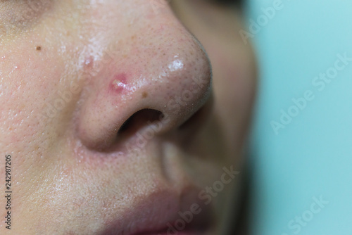 Young woman with acne problem,Close up of acne on the face skin caused by the hormone and the scars, acne inflammation . photo