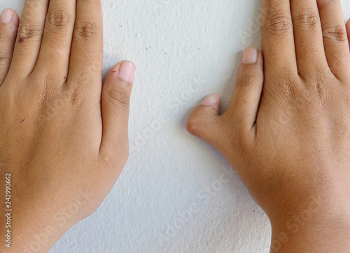 Polydactyly on human; rare abnormal characteristic causes by chromosome. photo