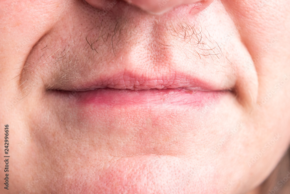 Stockfoto Real female mustache. Signs of male hormones on female