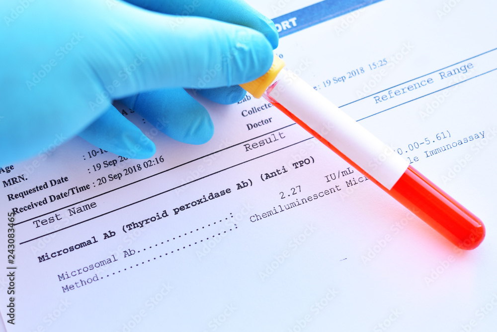 Laboratory result of microsomal antibody or anti-TPO test, autoimmune diagnosis Laboratory result of microsomal antibody or anti-TPO test, autoimmune diagnosis