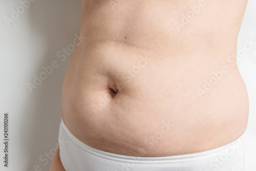 Excessive belly fat on white background. Umbilical hernia.