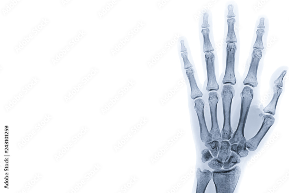 X-ray image of left hand isolated on white background with copy space and background. X-ray image of left hand isolated on white background with copy space and background.