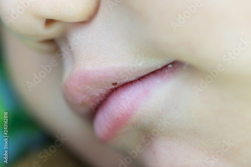 teenager's nose close up