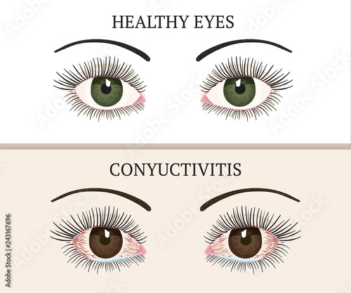 Eye disease. Ophthalmology health illustration.