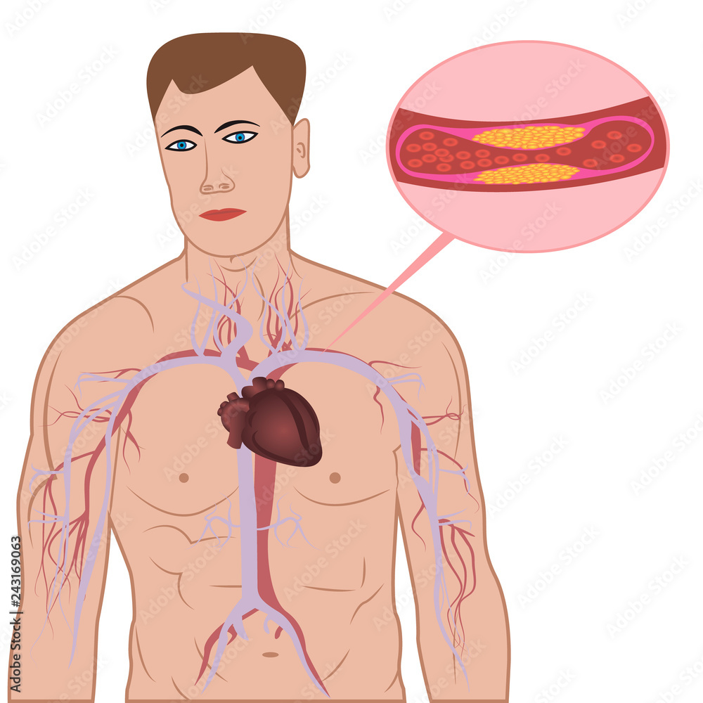 Levels of cholesterol plaque in vessels Stock Vector Adobe Stock