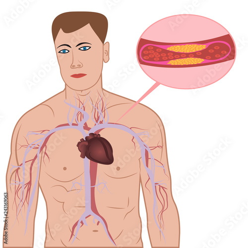 Levels of cholesterol plaque in vessels