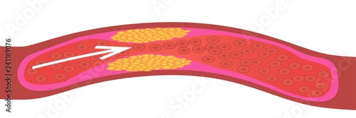 Levels of cholesterol plaque in vessels