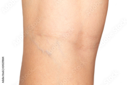 varicose veins on the back of the knee of a young caucasian woman
