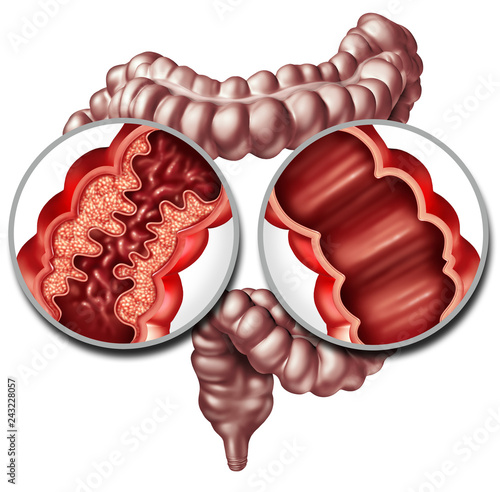 Crohn Disease And Healthy Intestine photo