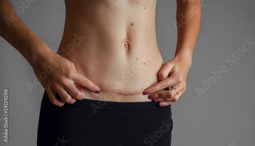 Closeup of woman belly with a scar from a cesarean section photo