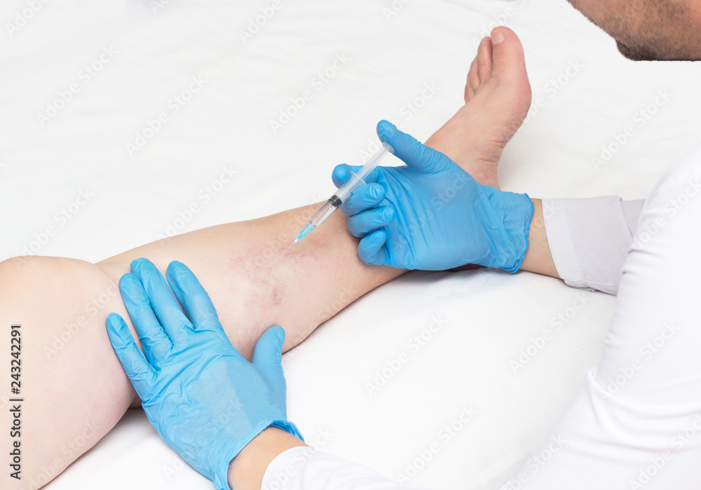 Doctor performs sclerotherapy for varicose veins on the legs, varicose vein treatment, copy space, injection