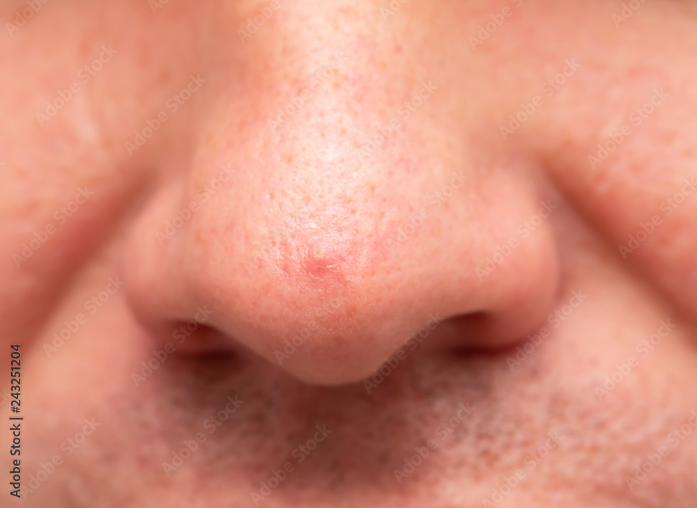 pimple on the nose pimple on the nose