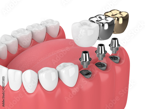 3d render of teeth with implants photo